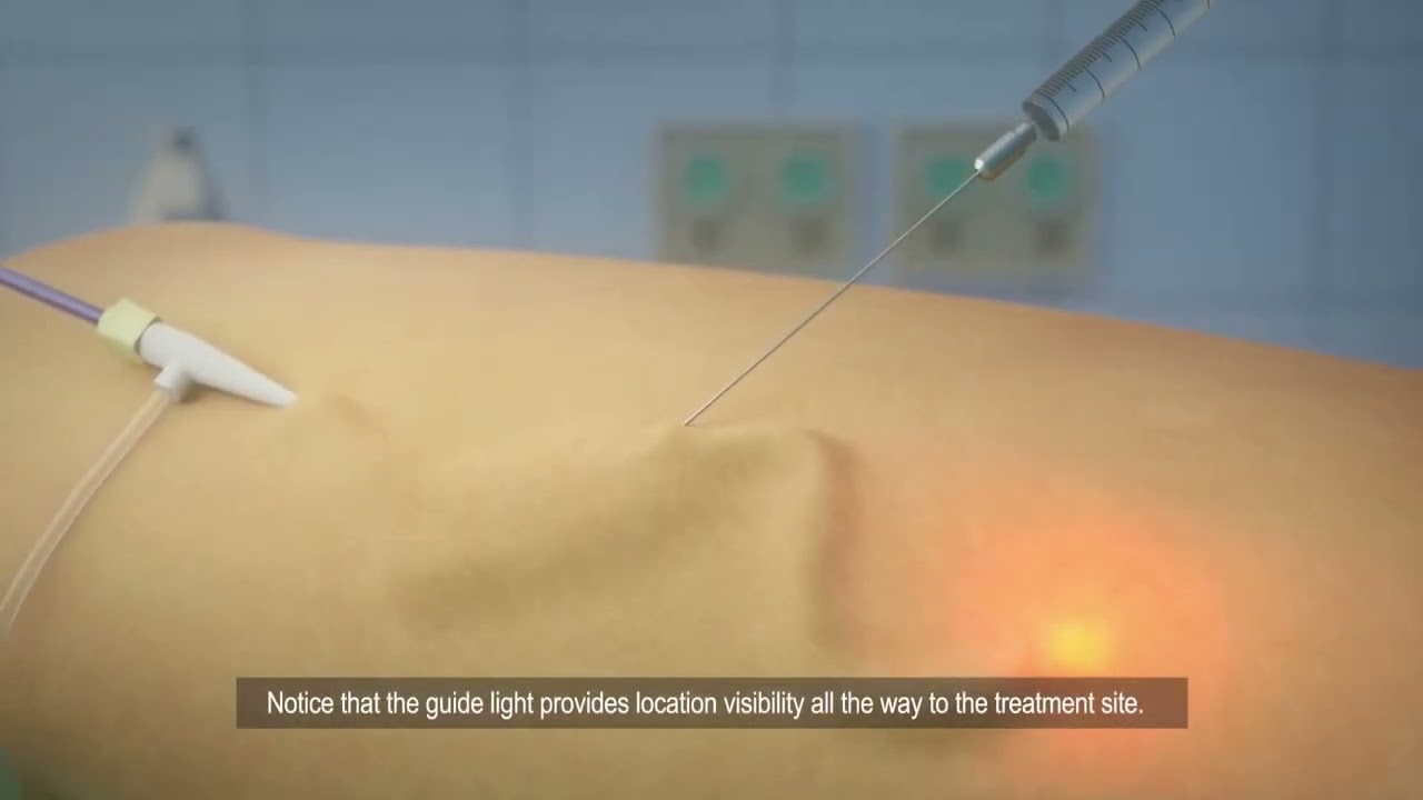 VENISTAR procedure