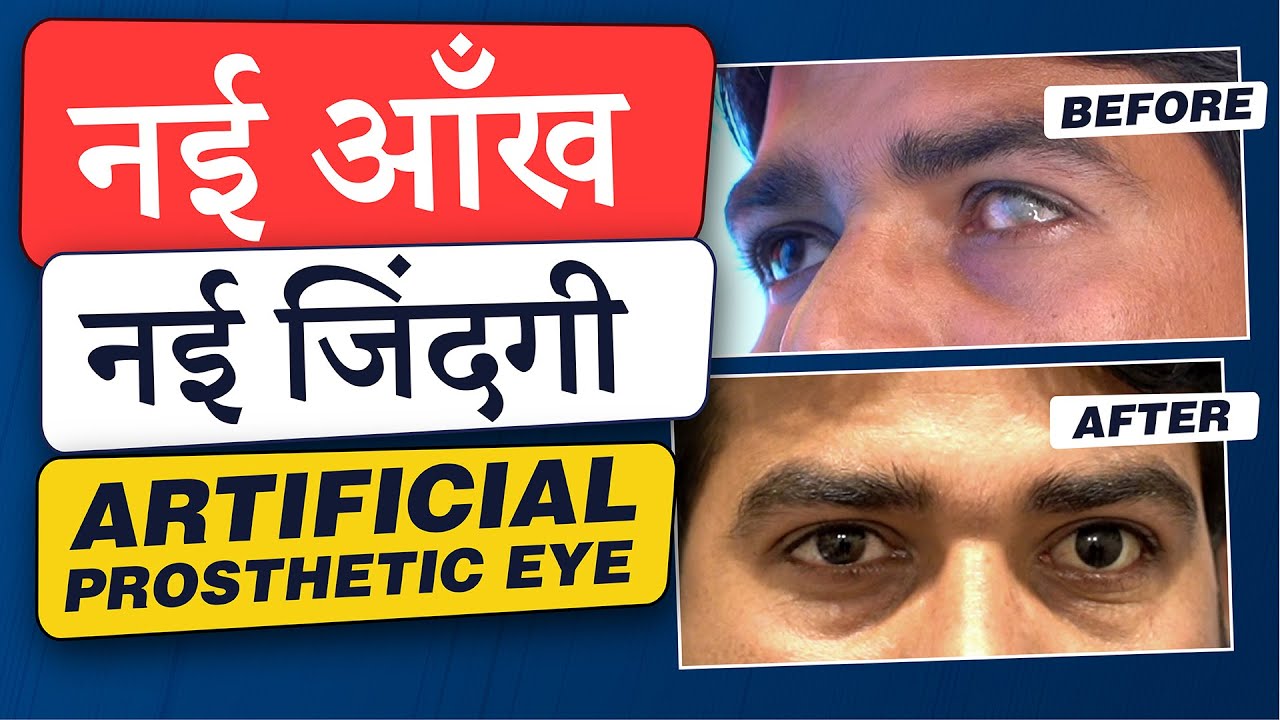 Artificial (Prosthetic) Eye which Moves & Looks like Natural Eye | नकली आँख लगाने का ऑपरेशन
