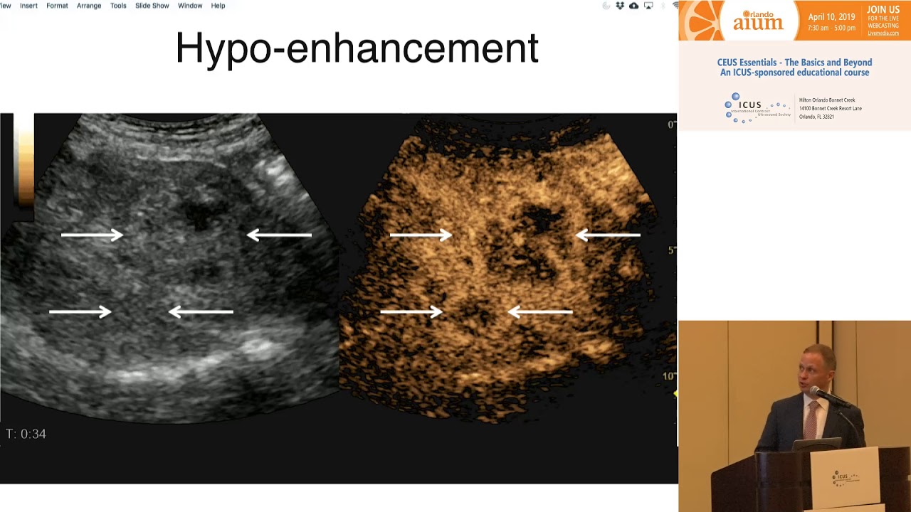 HCC Diagnosis and LI-RADS
