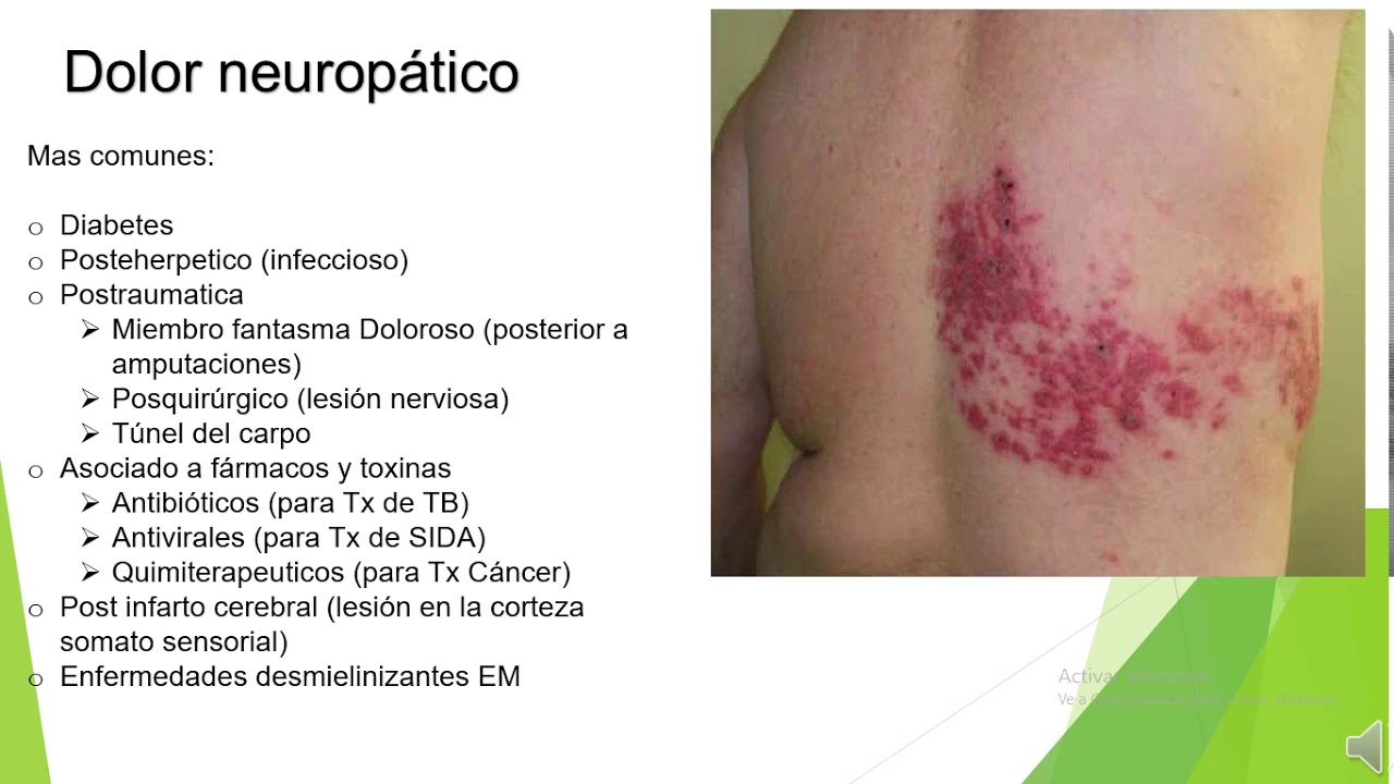 DOLOR  NEUROPATICO