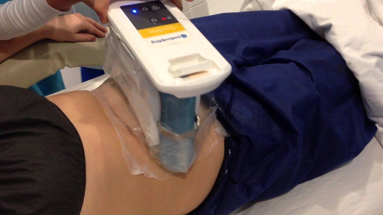 CoolSculpting Los Angeles - Freeze Away Belly Fat Procedure with Before and After Results