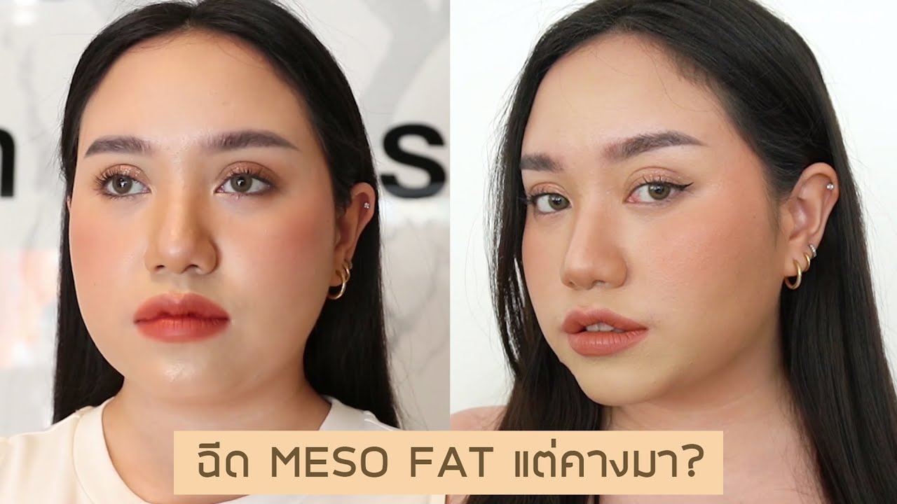 ฉีด meso fat (อีกแล้ว😂)​ ลดแก้ม ลดเหนียง แต่คางดันมา!! | LADY FRIDAY