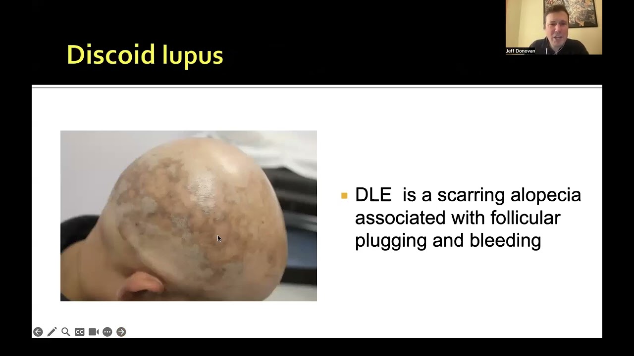 Scarring Alopecia Summit   Other Types Breakout Room