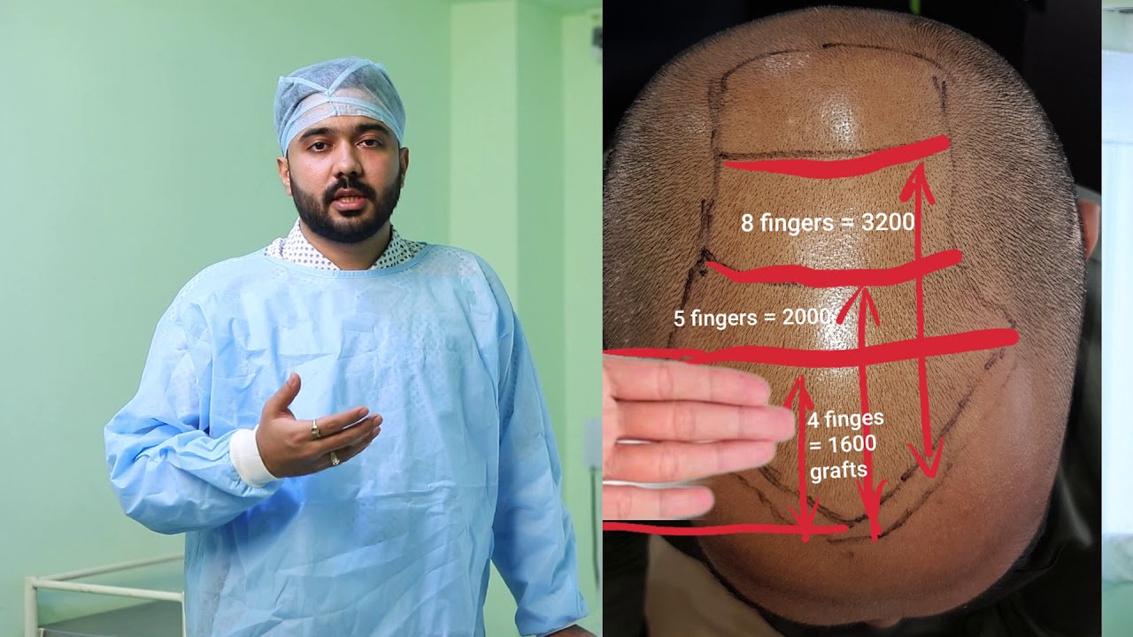 Hair transplant  | How to get best results from Hair Transplant | The truth about Hair Transplant