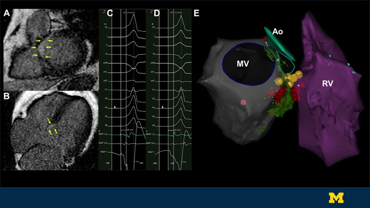 Catheter ablation of parahisian premature ventricular complexes inpatients with and without cardiac