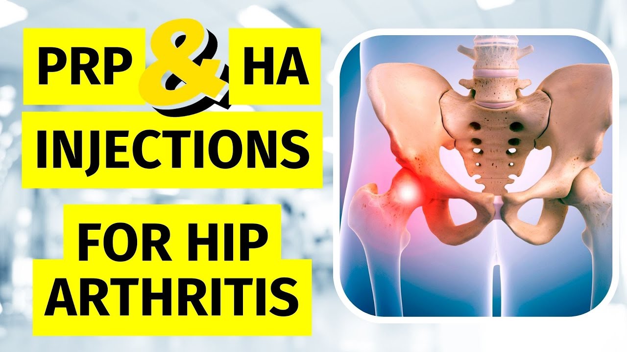 Hyaluronic Acid & Platelet Rich Plasma Injection for Hip Arthritis