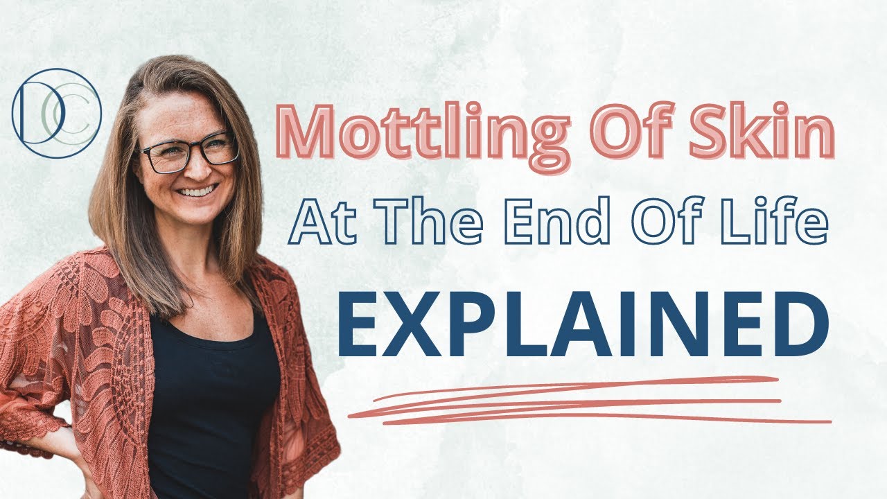 Mottling of Skin at the End Of Life