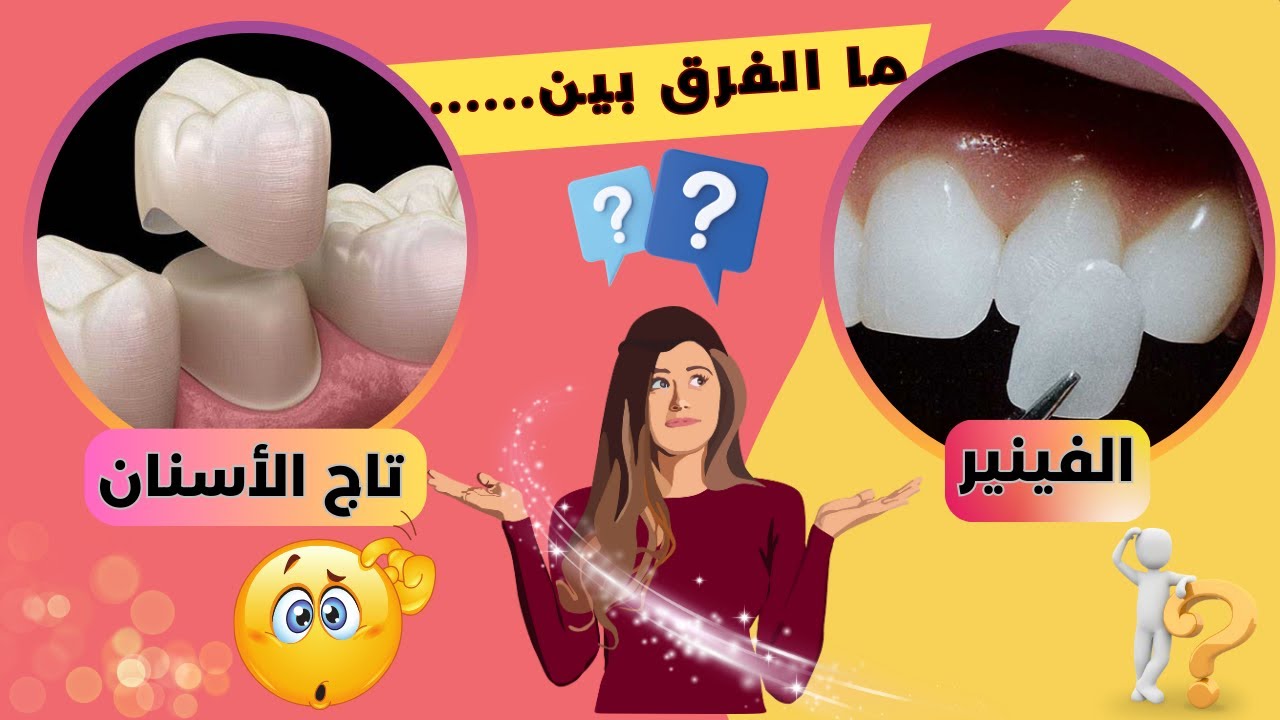 علاج الاسنان |ما الفرق بين الفينير وتاج الاسنان؟| حكاية أسناني؟.