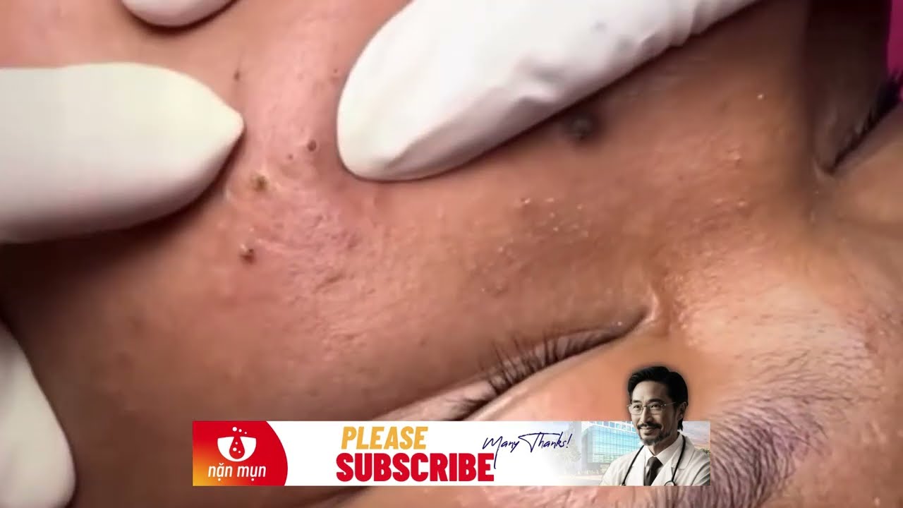[EP 50] NẶN MỤN ĐẦU ĐEN, ĐẦU TRẮNG NHANH, HIỆU QUẢ | ACNE SQUEEZING FAST & EFFECTIVE | © Nặn Mụn