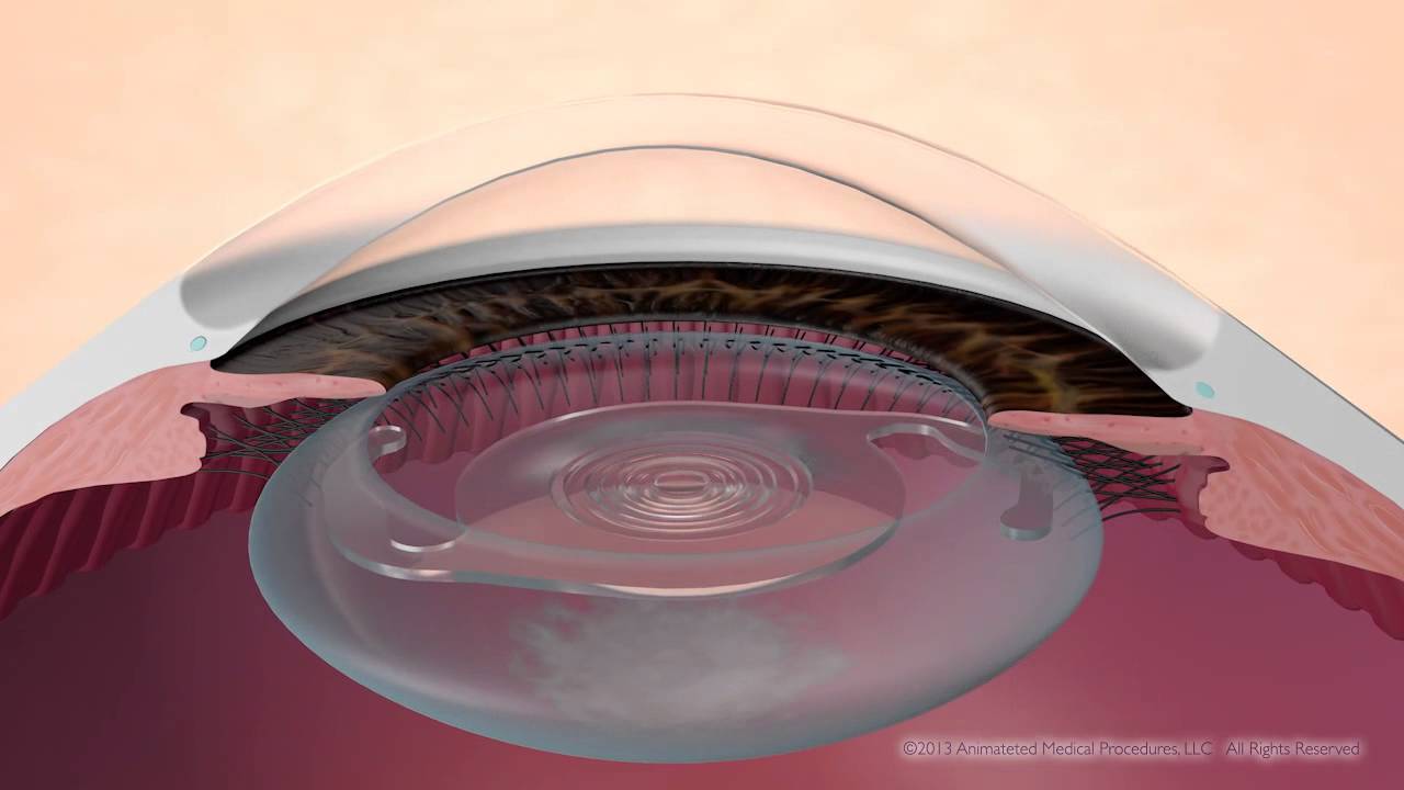 Secondary Cataract Treatment