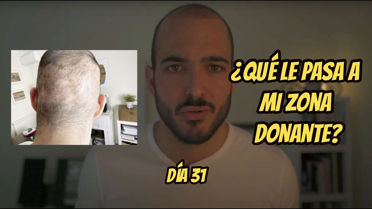 ¿Qué le pasa a mi zona donante? 31 DÍAS DESPUÉS DE MI TRASPLANTE CAPILAR