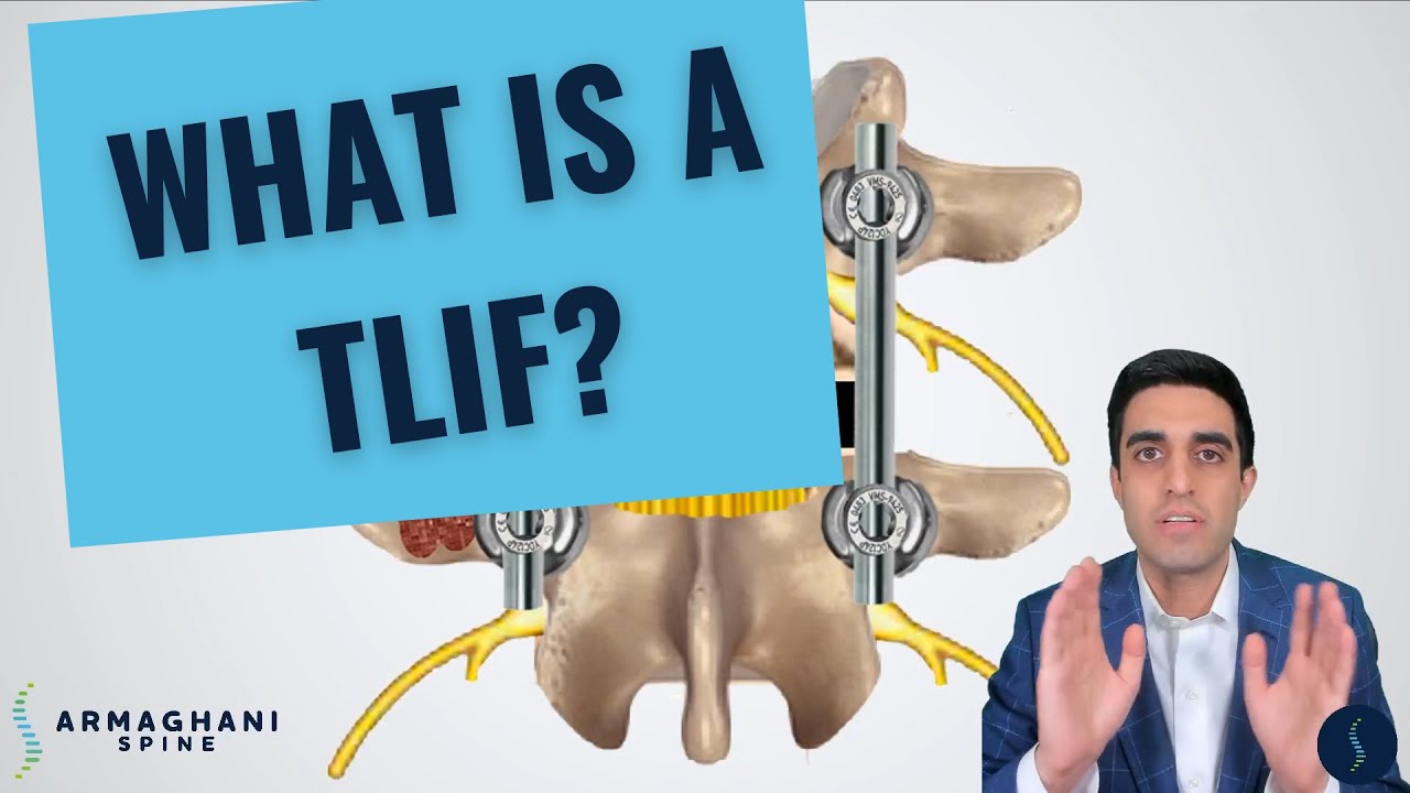 Как я провожу TLIF (и чего ожидать после)