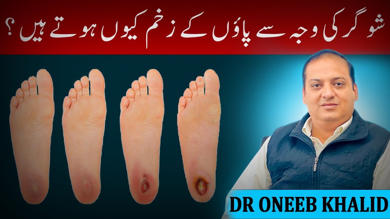 Diabetic foot kun banty hain BY DR. ONEEB KHALID