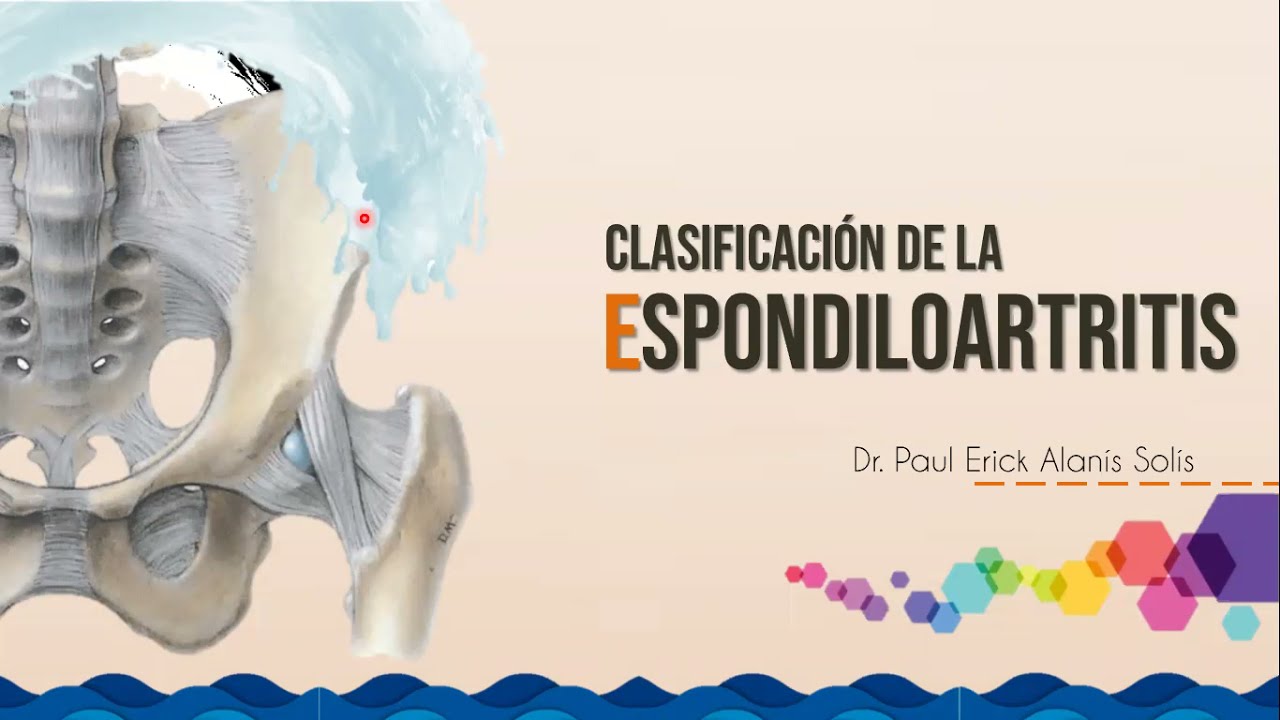 Clasificación de las Espondiloartritis