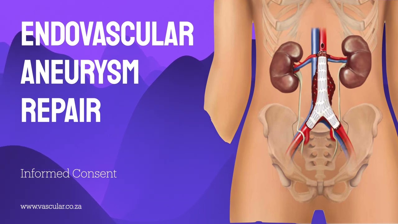 Endovascular Abdominal Aorta Aneurysm Repair - Informed Consent