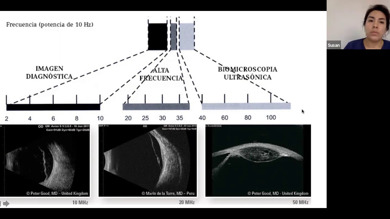 EVALUACION ECOGRAFICA DE GLOBO OCULAR