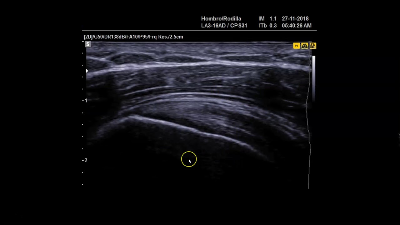 Sonopatologia del hombro
