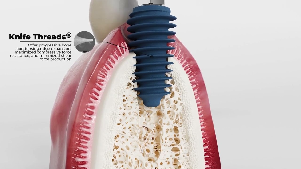 🦷𝗔𝗻𝘆𝗥𝗶𝗱𝗴𝗲 𝗜𝗺𝗽𝗹𝗮𝗻𝘁 - MegaGen