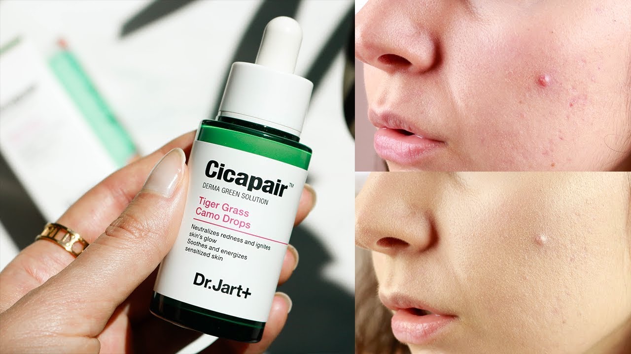 HOW TO COVER REDNESS FROM ACNE SCARS WITH DR. JART+ CICAPAIR TIGER GRASS CAMO DROPS | QUEENSHIRIN