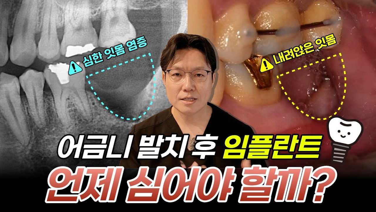 어금니 발치 후 임플란트 언제 식립해야 하나요? | 임플란트 수술 시기 총정리