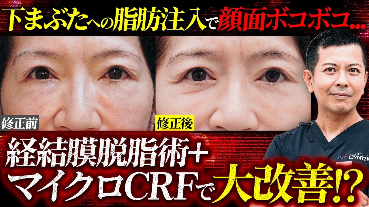 【危険】クマ治療と称して下まぶたに