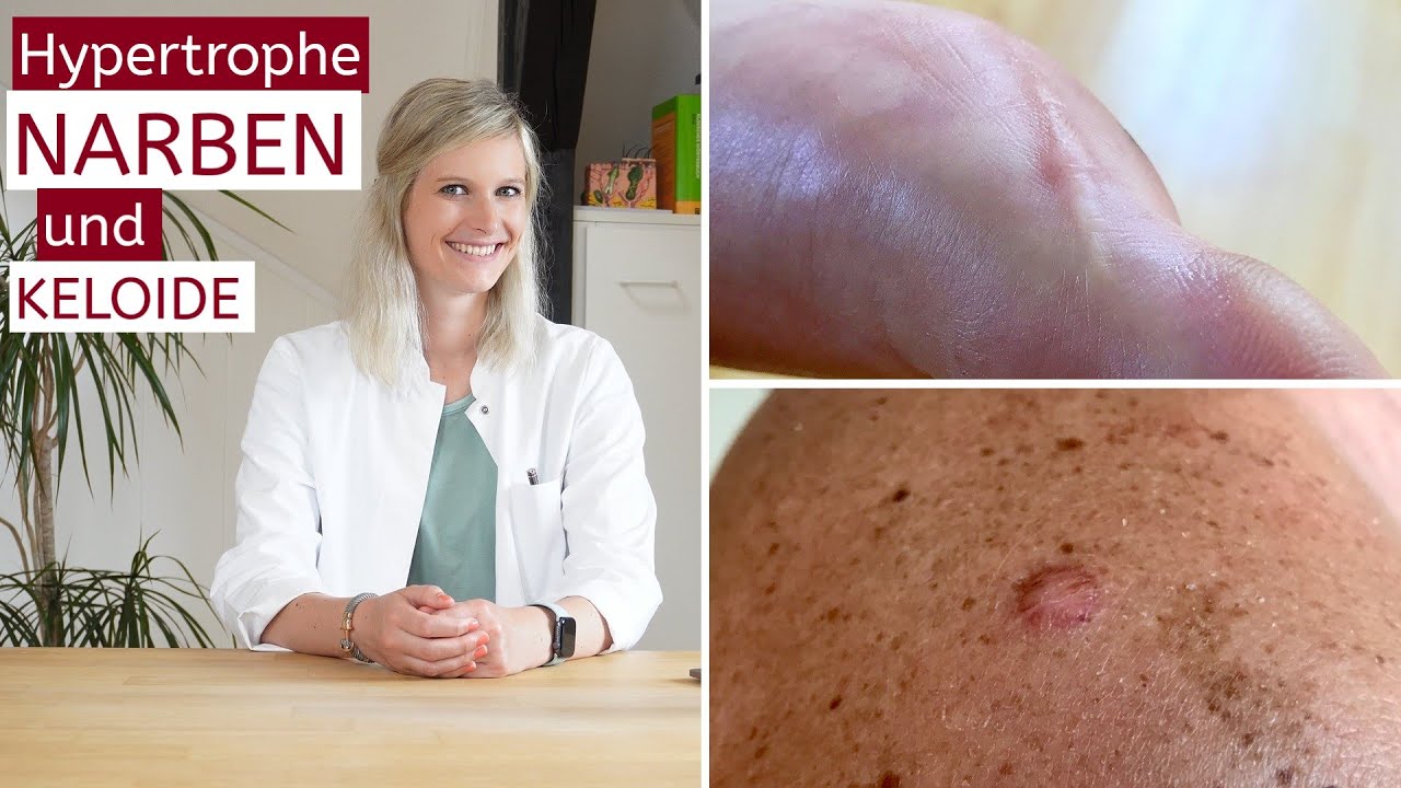 [4K] Hypertrophe Narben und Keloide | Vorbeugung | Tipps | Behandlung