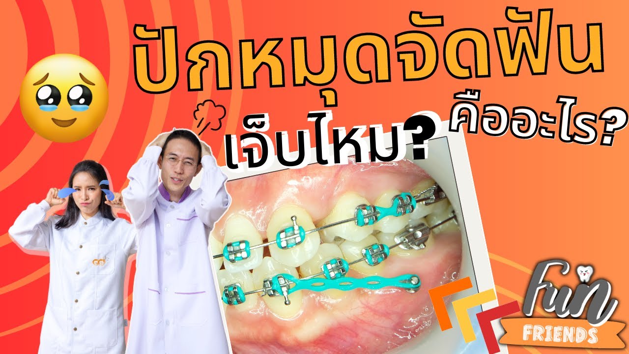หมุดจัดฟันคืออะไร ใส่ตอนไหน  ปักหมุดจัดฟันเจ็บไหม? |จัดฟันที่แท้ FunFriends เพื่อนกันฟันดี|