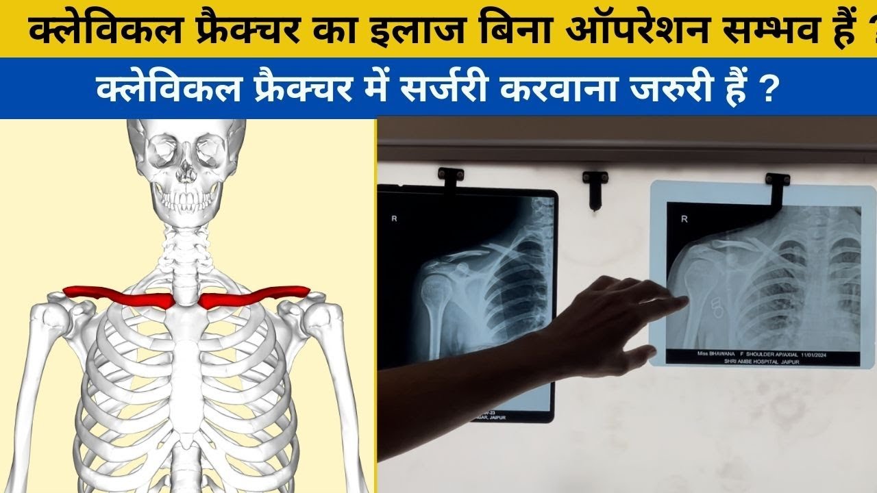 क्लेविकल (Clavicle या Collarbone) का फ्रैक्चर का बिना ऑपरेशन हुआ सफल इलाज