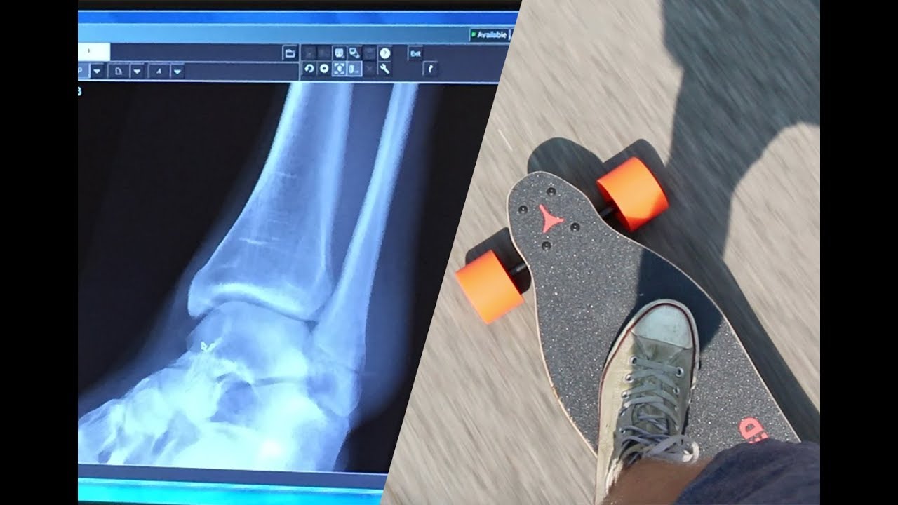 broke my ankle on a boosted board