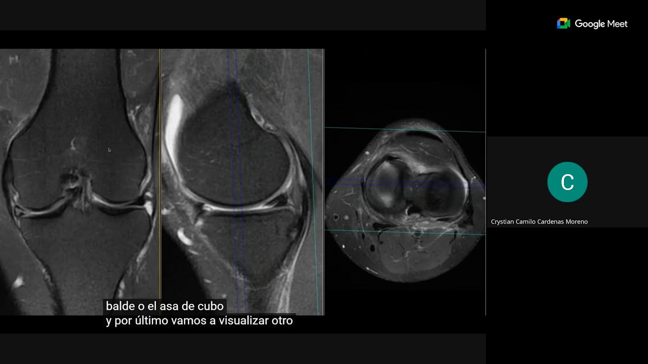 NATOMÍA RADIOLÓGICA Y PATOLOGÍA MENISCAL