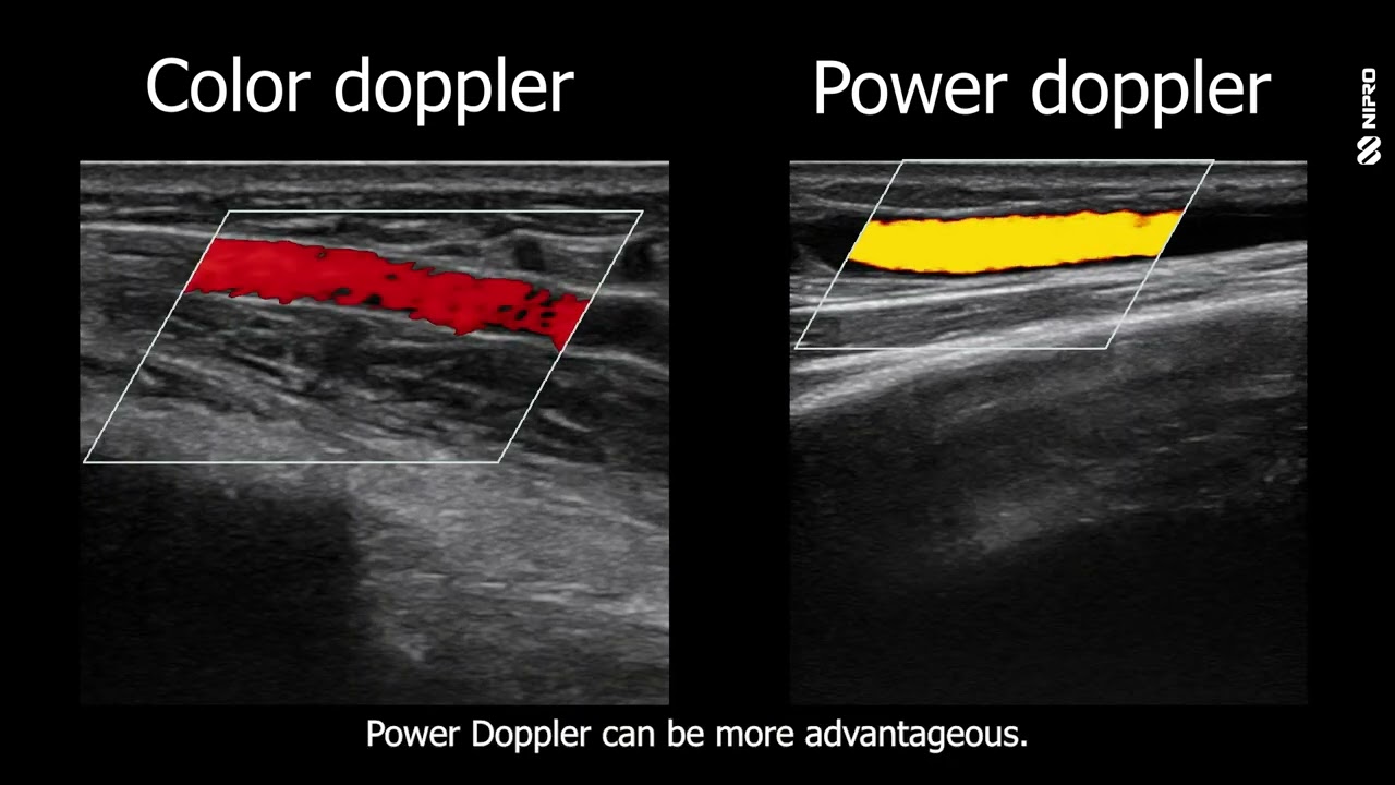 iMEP Tips & Tricks 30: Power Doppler vs. Color Doppler