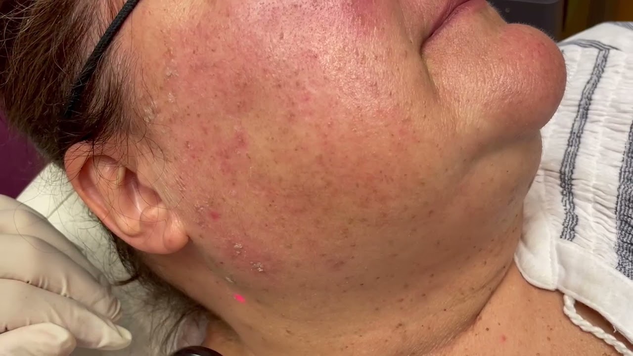 Removing Solar Lentignos & Seborrheic Keratosis (SK's) with Lasers