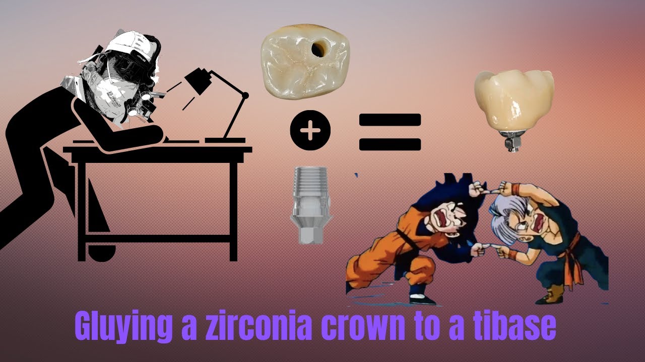 Cementing a screw retained zirconia crown to a tibase