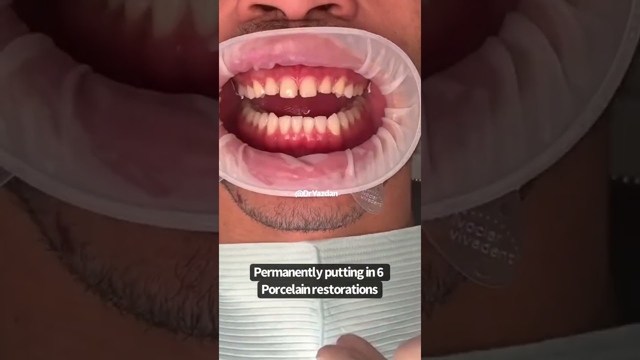 Porcelain veneers procedure | porcelain veneers before and after | cosmetic dentist | Dr. Yazdan