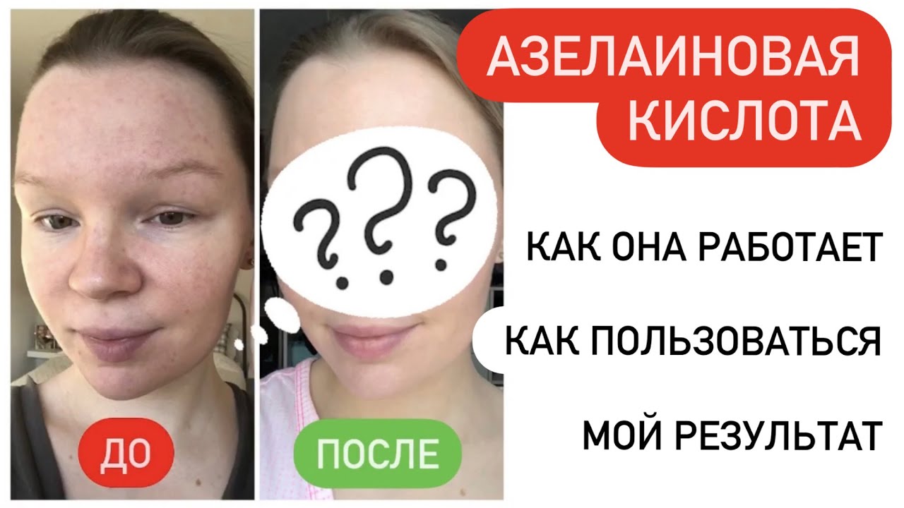 АЗЕЛАИНОВАЯ КИСЛОТА | Мой опыт использования + ФОТО | Как работает Азелик гель ?