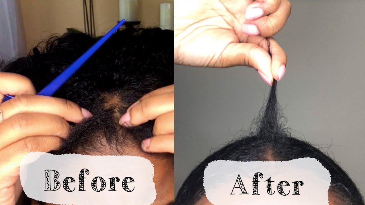 😱BALD SPOT: How I fixed mine and finally got it to grow back 😇