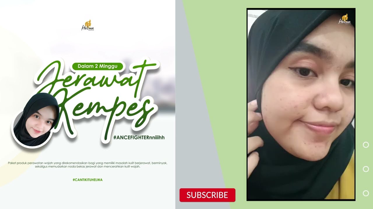 Testimoni Acne Series - Helwa Beautycare