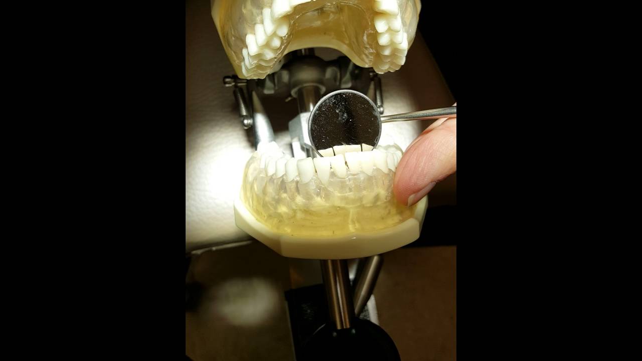 Curettage Anterior Teeth