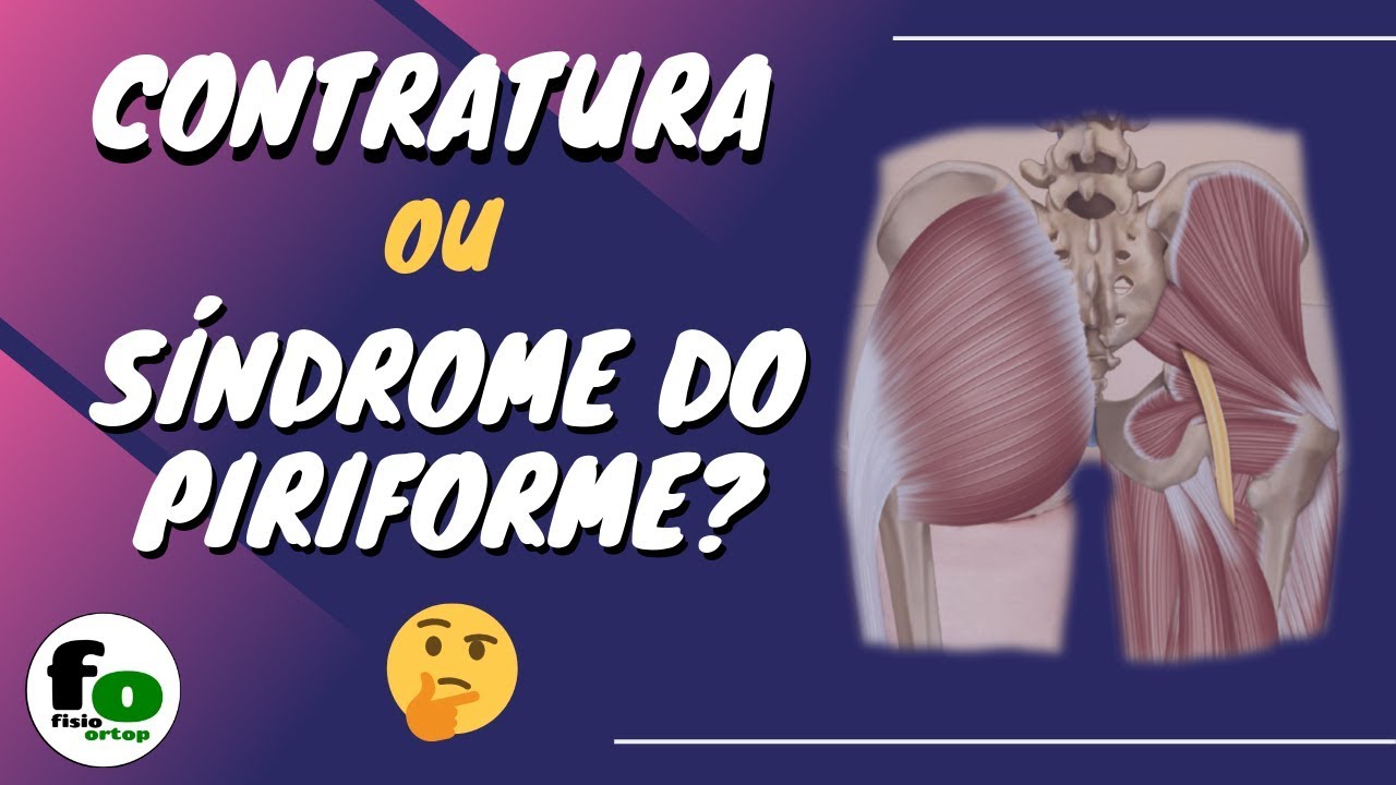 Contratura ou Síndrome do Piriforme? | Conheça as diferenças