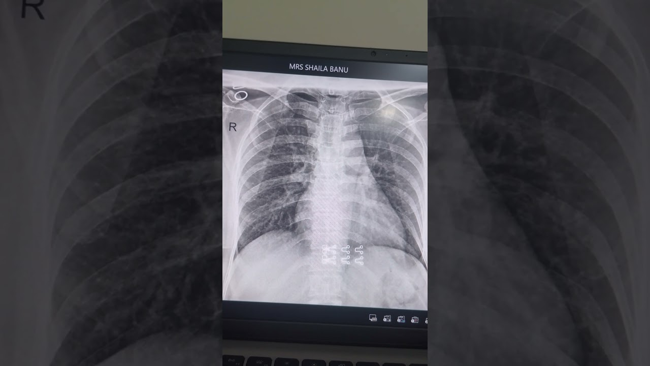 Chest X ray Anatomy For Freshers...... 