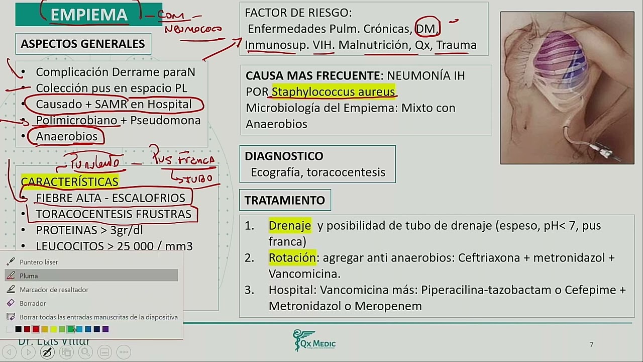 EMPIEMA Y QUILOTORAX RESIDENCIA