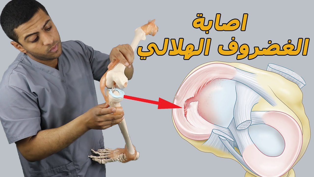 اصابة الغضروف الهلالي/أفضل7 تمارين لعلاج اصابة قطع الغضروف الهلالي نهائيا