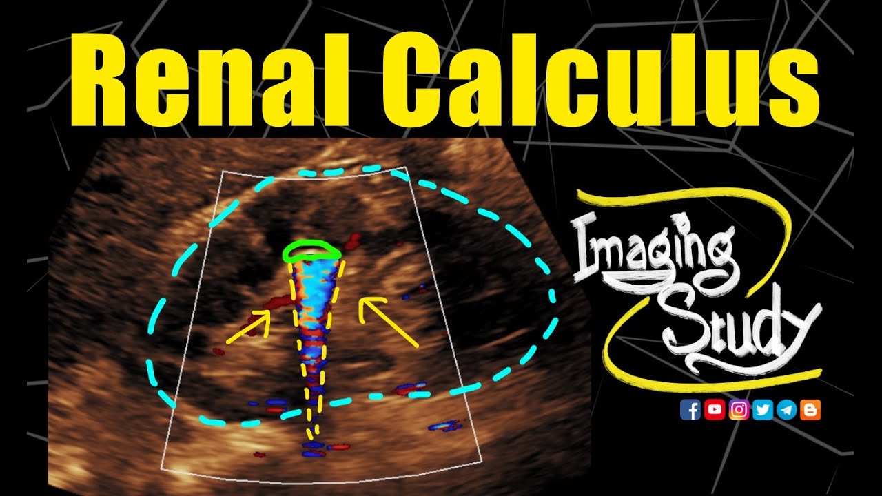 Renal Calculus || Nephrolithiasis || Twinkling Artifact || Ultrasound || Doppler || Case 248