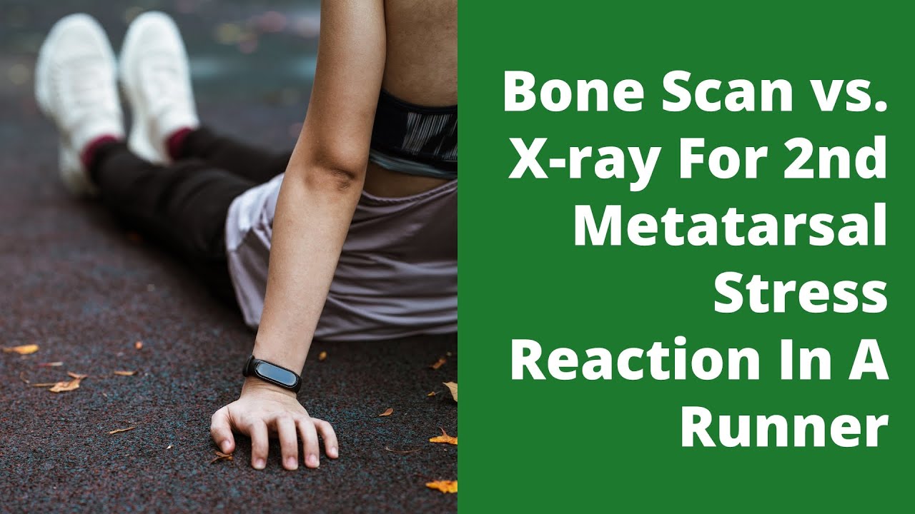 Bone Scan vs. X-ray For 2nd Metatarsal Stress Reaction In A Runner