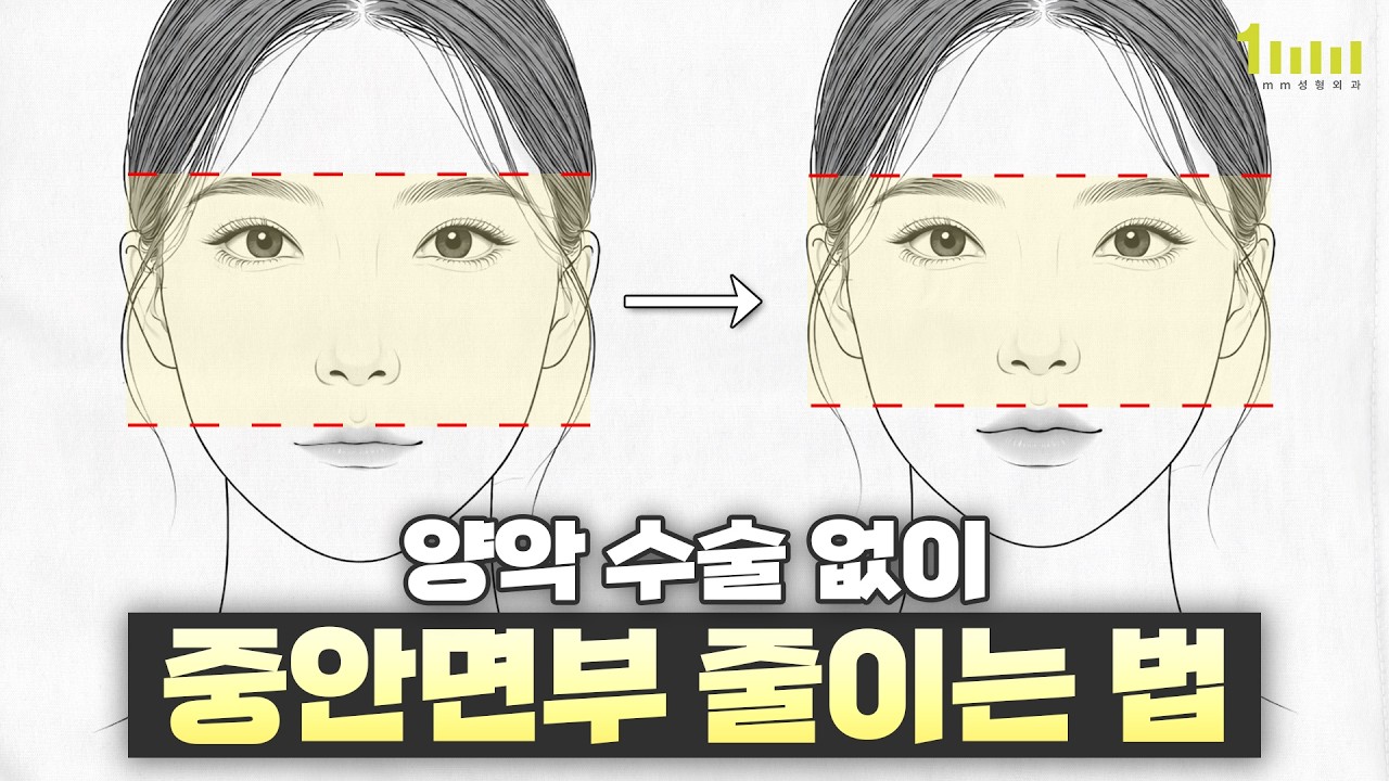 양악 수술 없이 중안면부 줄이는 법