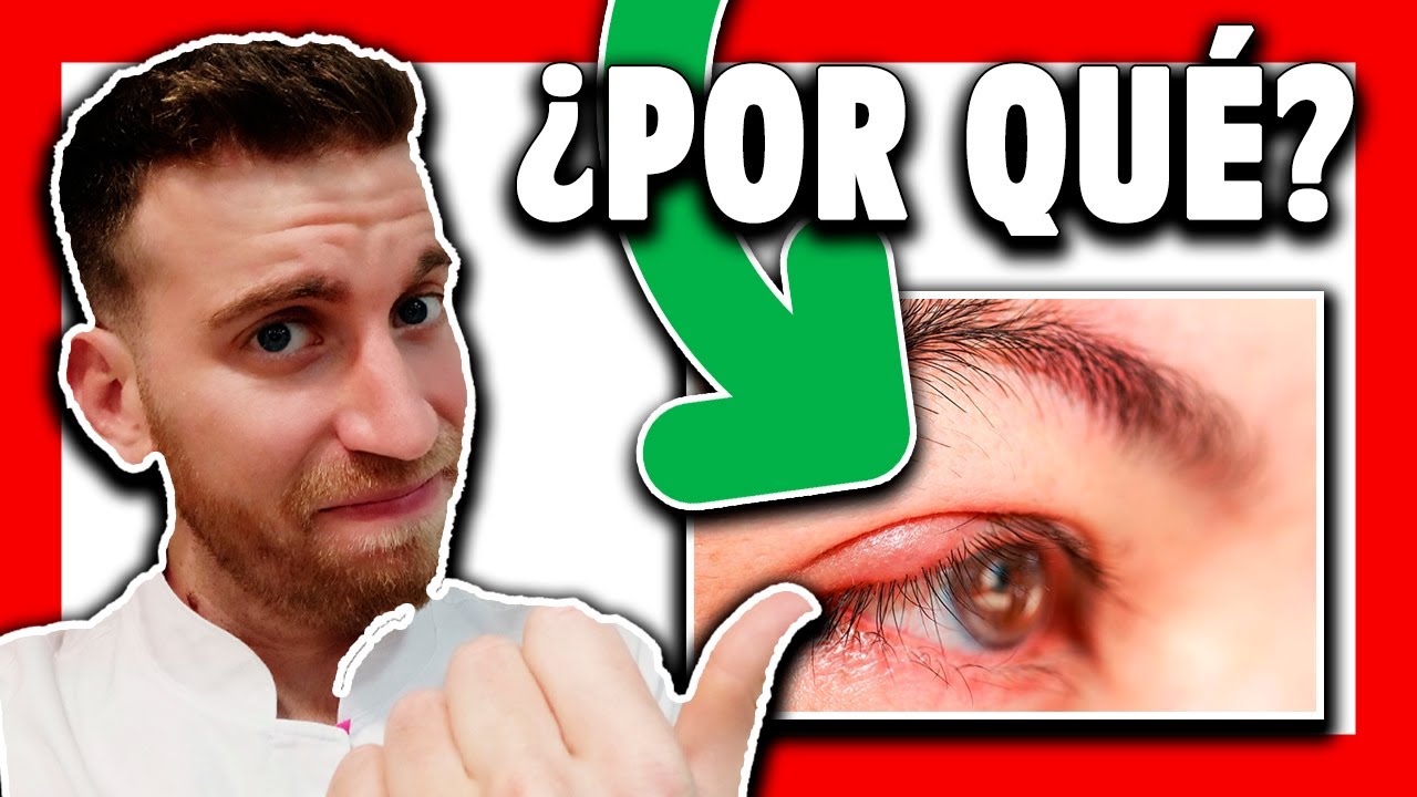 🔴 ¿Qué es el CHALAZIÓN y por qué sale? [Cap. #1]