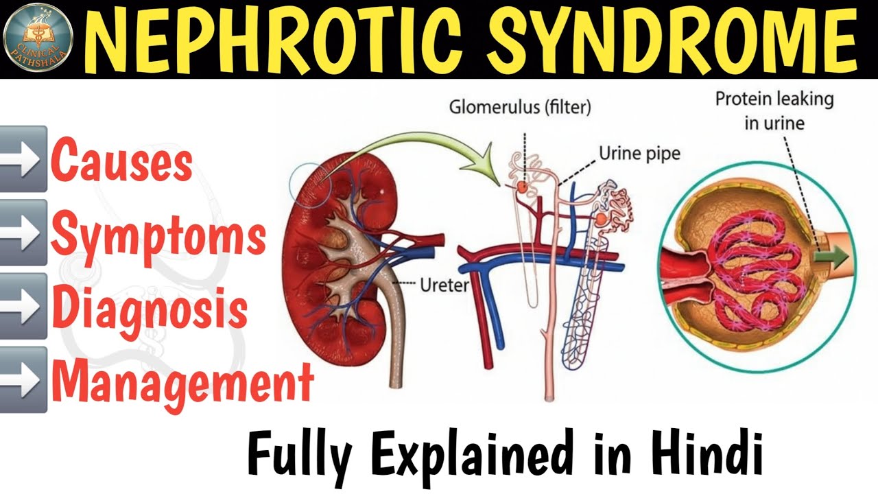 Nephrotic Syndrome | Pathophysiology | Causes | Types | Symptoms | Diagnosis & Management