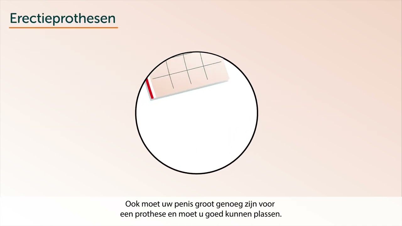 Genitale chirurgie (vermannelijking): prothesen