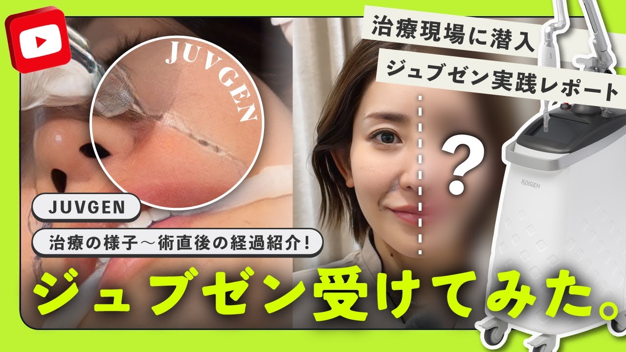💉ほうれい線治療の革命児！ジュブゼン（JUVGEN）ってどんな治療か受けてみた！【ジュブゼン】#ジュブゼン #juvgen