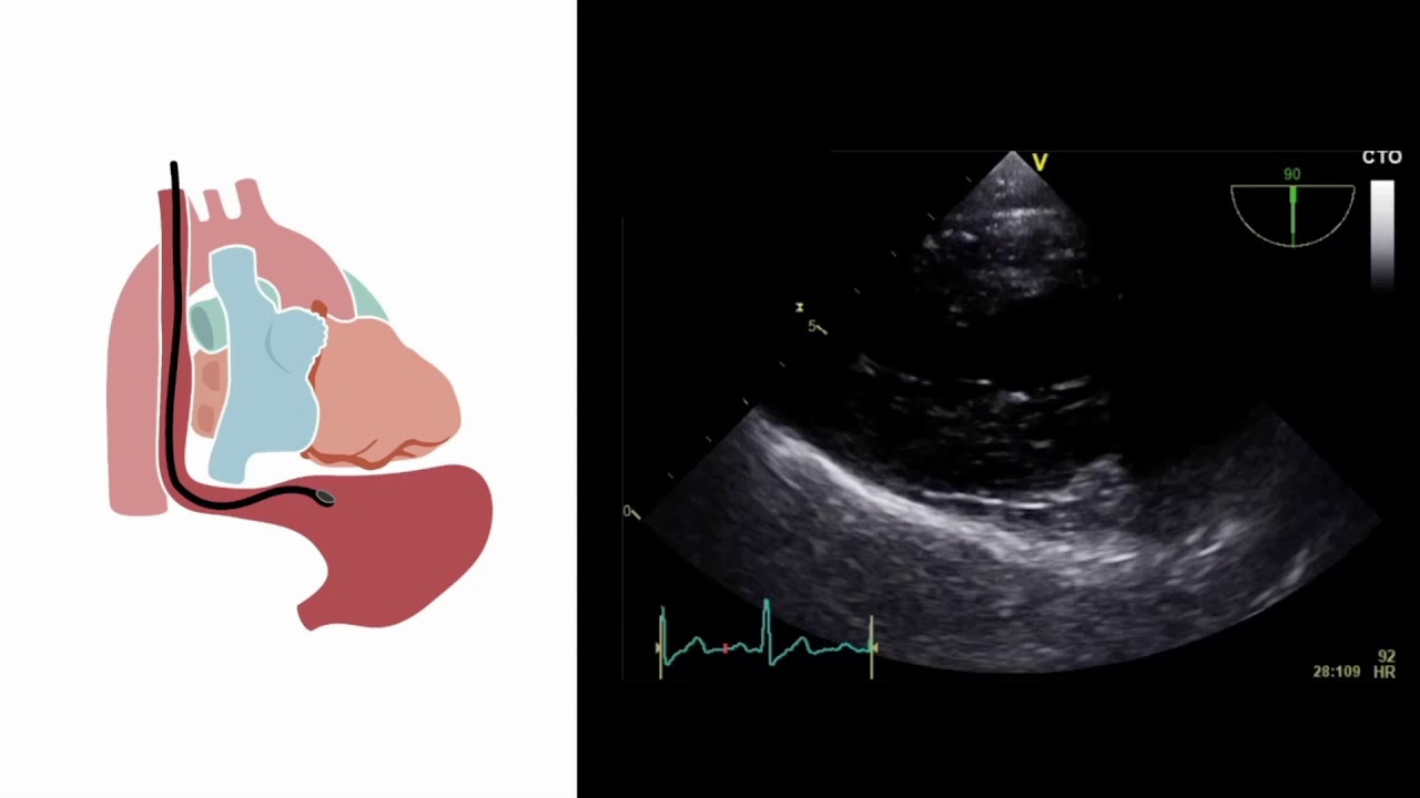 Mastering important TEE views (transesophageal echocardiography)